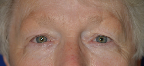 Eyelid Lift Before