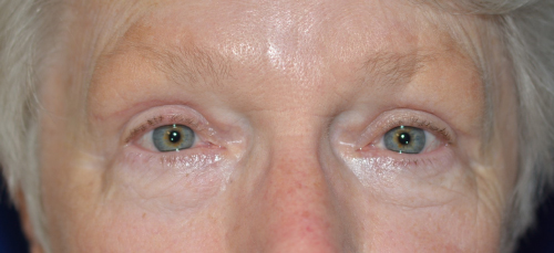 Eyelid Lift After