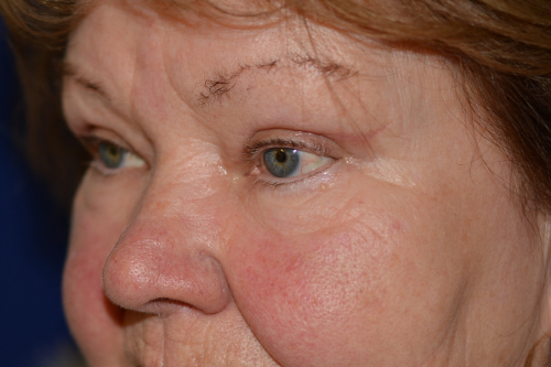 Eyelid Lift After