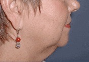 Facelift & Neck Lift Before