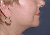 Facelift & Neck Lift Before After