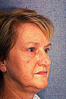 Facelift & Neck Lift Before
