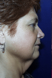 Facelift & Neck Lift Before