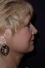 Facelift & Neck Lift Before After