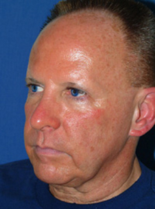 Facelift & Neck Lift Before