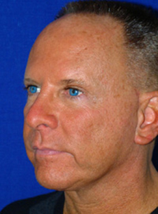 Facelift & Neck Lift Before After