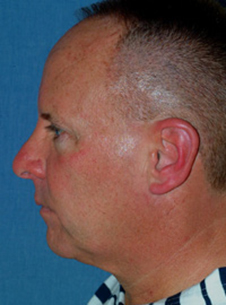Facelift & Neck Lift Before