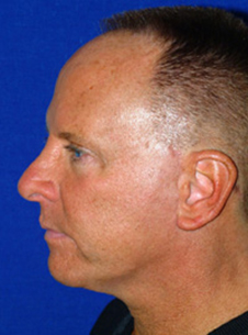 Facelift & Neck Lift Before After