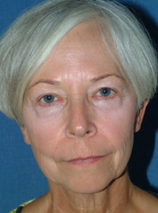 Facelift & Neck Lift Before