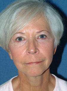 Facelift & Neck Lift Before After