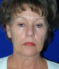 Facelift & Neck Lift Before