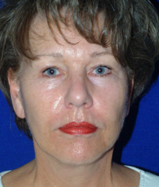 Facelift & Neck Lift Before After