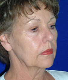 Facelift & Neck Lift Before