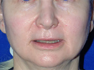 Laser After