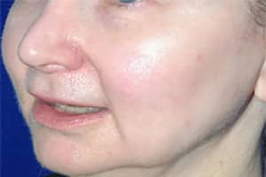 Laser After