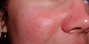 Laser Before