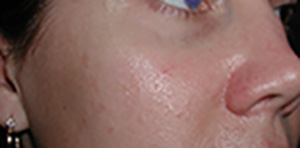 Laser After