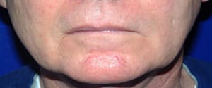 Laser Before