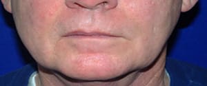 Laser After