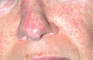 Laser After