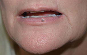 Laser Before