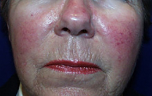 Laser Before