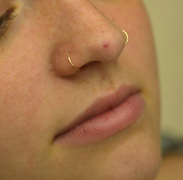 Laser Before