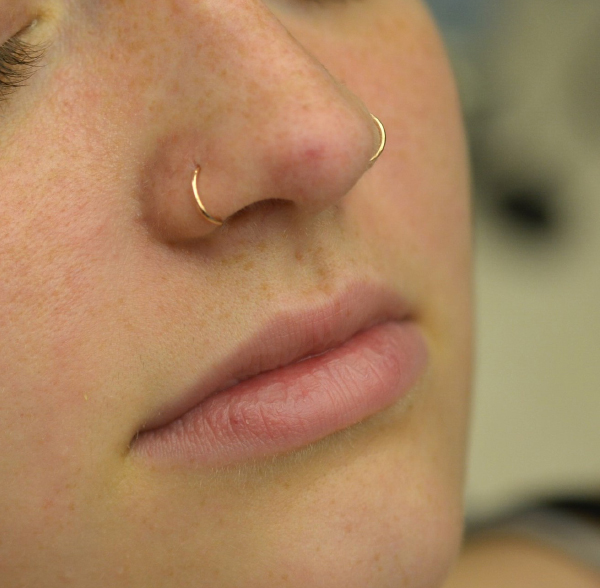 Laser After