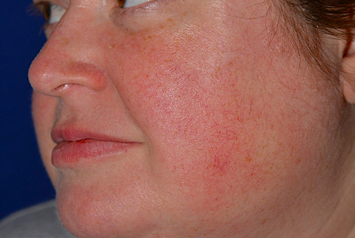 Laser Before
