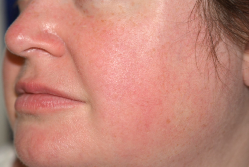 Laser After