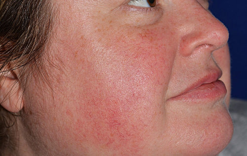 Laser Before