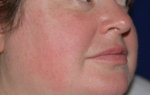 Laser After