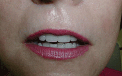 Lip Enhancement After