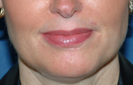 Lip Enhancement After