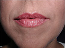 Lip Enhancement Before