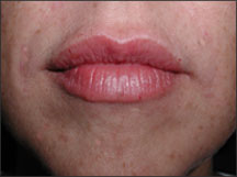 Lip Enhancement After