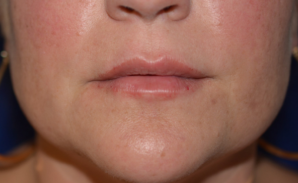 Lip Enhancement After