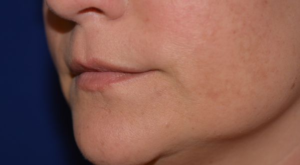 Lip Enhancement Before