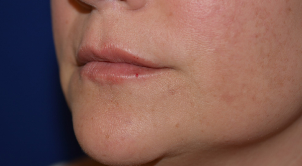 Lip Enhancement After