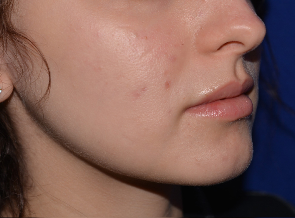 Lip Enhancement Before