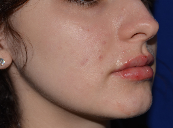 Lip Enhancement After