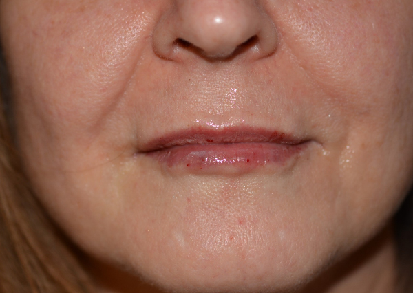 Lip Enhancement After