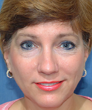 Nose Reshaping Before