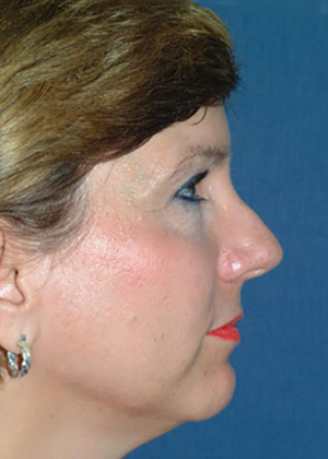 Nose Reshaping Before
