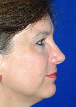 Nose Reshaping After