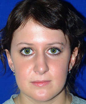 Nose Reshaping After