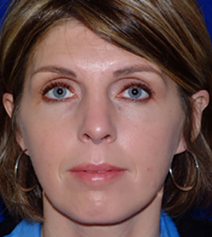 Nose Reshaping After