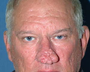 Nose Reshaping Before