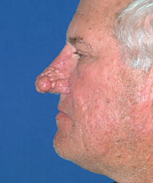 Nose Reshaping Before