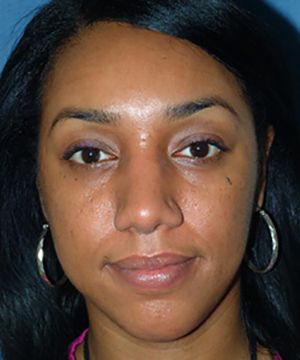 Nose Reshaping After